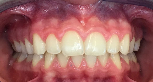 Foto del sorriso del paziente dopo la cura