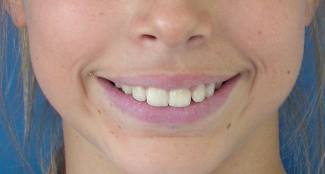 Foto del sorriso del paziente prima della cura