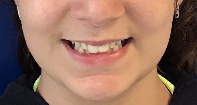 Foto del sorriso del paziente prima della cura