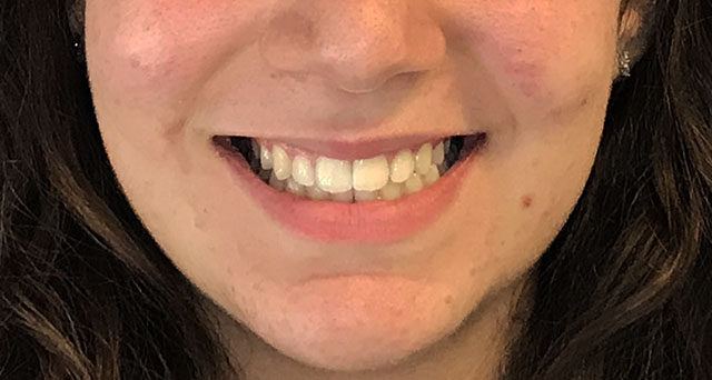 Foto del sorriso del paziente dopo la cura