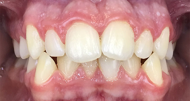 Foto del sorriso del paziente prima della cura