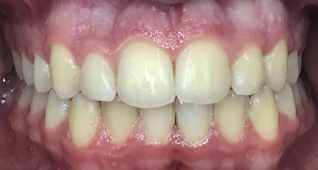 Foto del sorriso del paziente dopo la cura