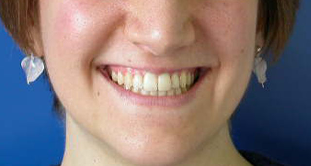 Foto del sorriso del paziente dopo la cura