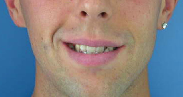 Foto del sorriso del paziente prima della cura