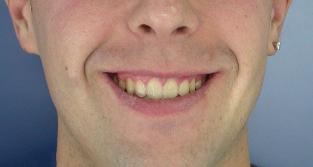 Foto del sorriso del paziente dopo la cura