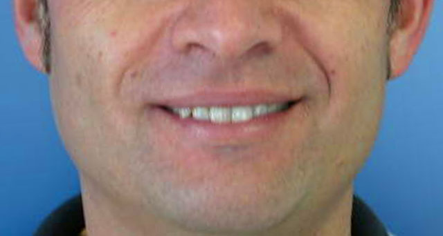 Foto del sorriso del paziente prima della cura