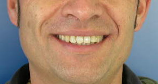 Foto del sorriso del paziente dopo la cura