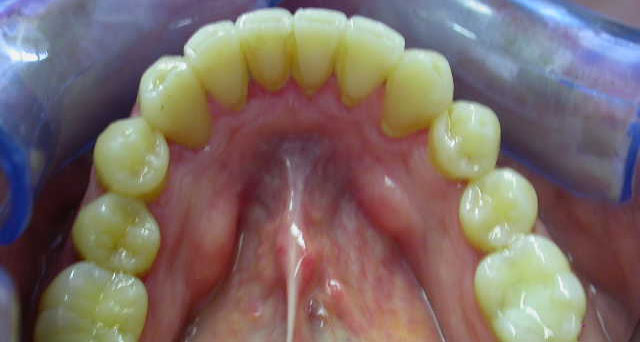 Foto del sorriso del paziente dopo la cura