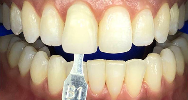 Foto del sorriso del paziente prima della cura