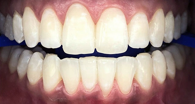 Foto del sorriso del paziente dopo la cura