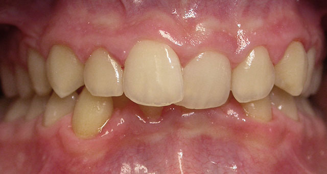 Foto del sorriso del paziente prima della cura