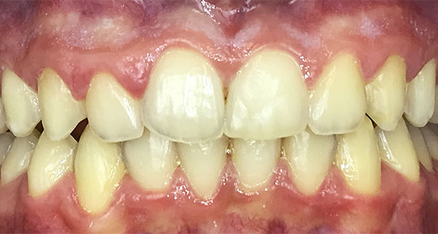 Foto del sorriso del paziente dopo la cura