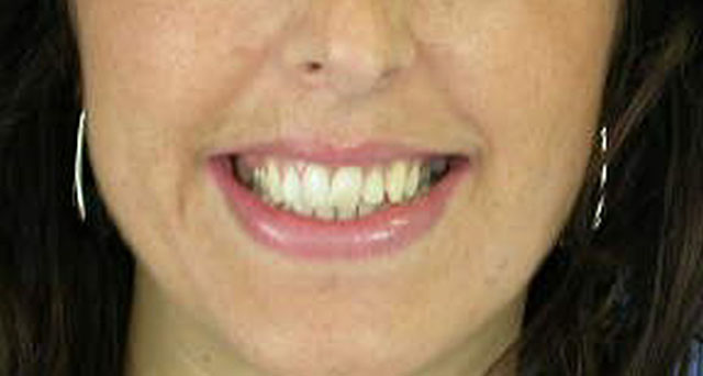 Foto del sorriso del paziente prima della cura