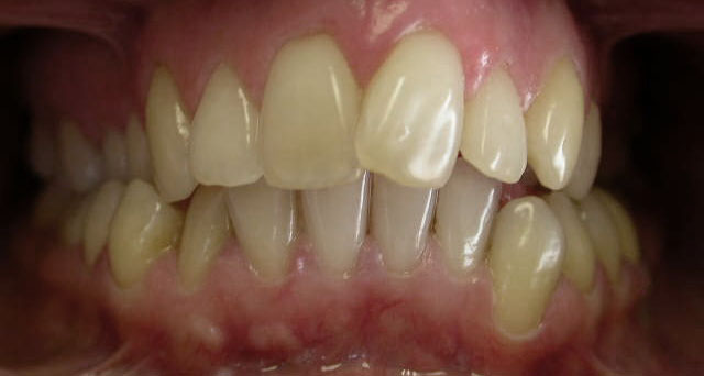 Foto del sorriso del paziente prima della cura