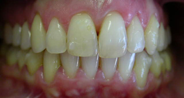 Foto del sorriso del paziente dopo la cura