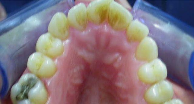 Foto del sorriso del paziente prima della cura