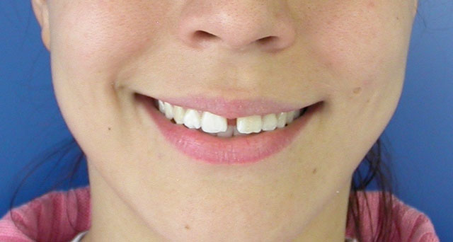 Foto del sorriso del paziente prima della cura