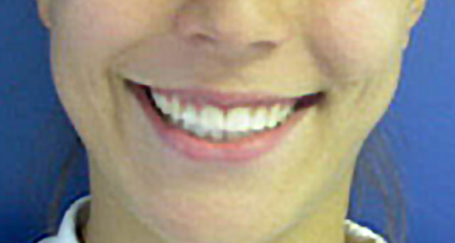 Foto del sorriso del paziente dopo la cura