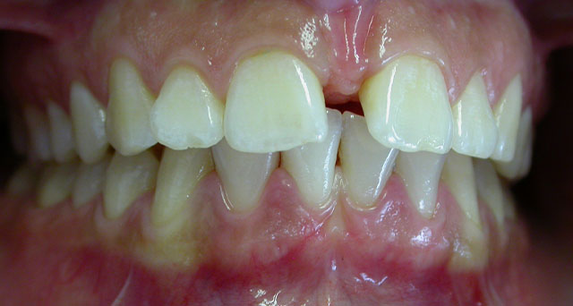 Foto del sorriso del paziente prima della cura