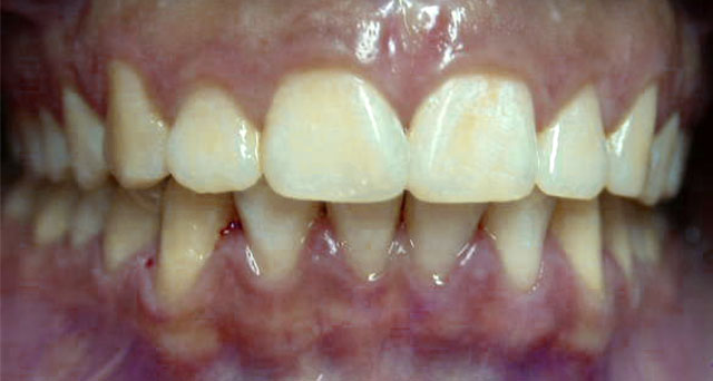 Foto del sorriso del paziente dopo la cura