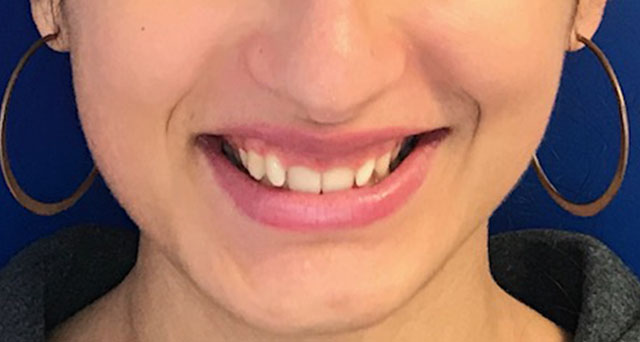 Foto del sorriso del paziente prima della cura