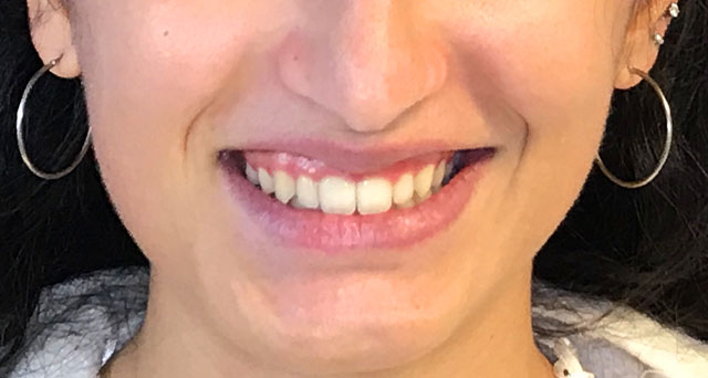 Foto del sorriso del paziente dopo la cura