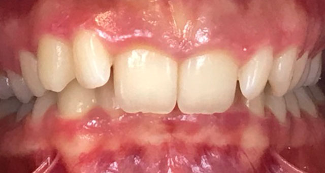 Foto del sorriso del paziente prima della cura