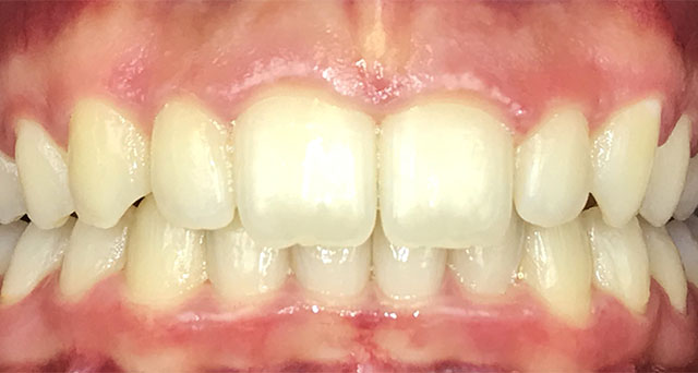 Foto del sorriso del paziente dopo la cura