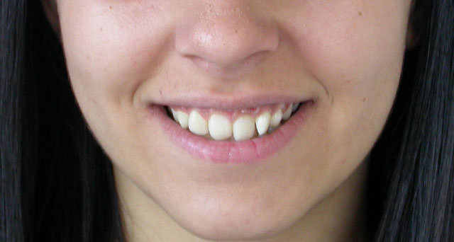 Foto del sorriso del paziente prima della cura