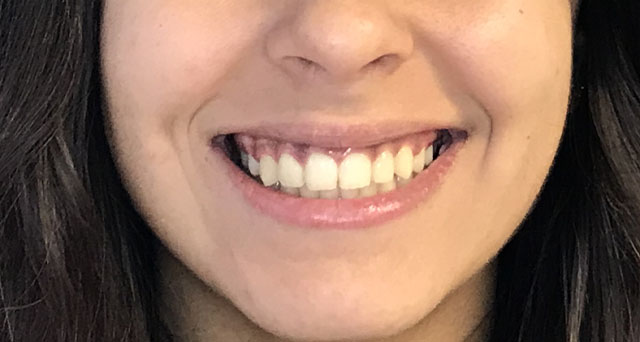 Foto del sorriso del paziente dopo la cura