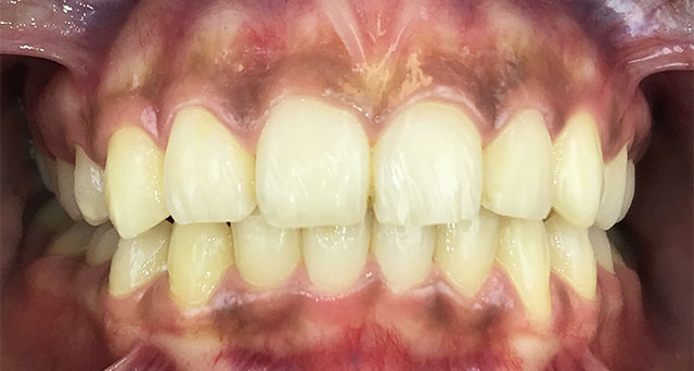 Foto del sorriso del paziente dopo la cura
