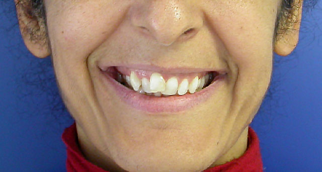 Foto del sorriso del paziente prima della cura