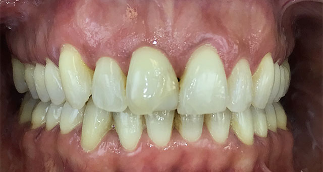 Foto del sorriso del paziente dopo la cura
