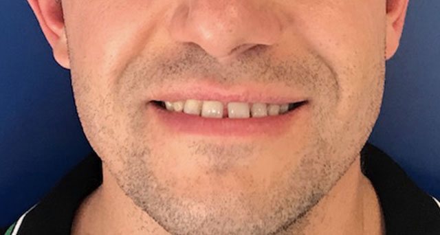 Foto del sorriso del paziente prima della cura
