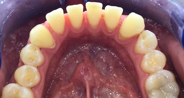 Foto del sorriso del paziente prima della cura