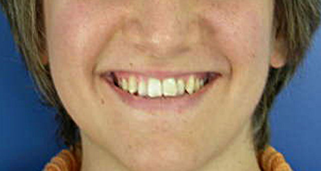 Foto del sorriso del paziente prima della cura