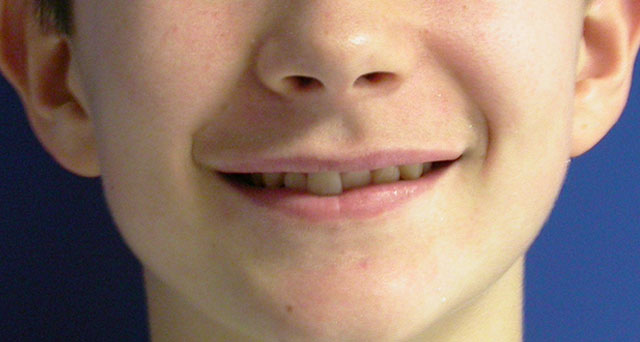 Foto del sorriso del paziente prima della cura