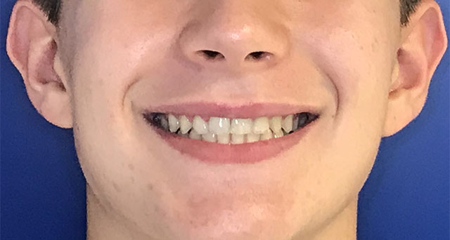 Foto del sorriso del paziente dopo la cura