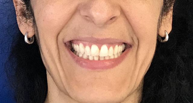 Foto del sorriso del paziente dopo la cura